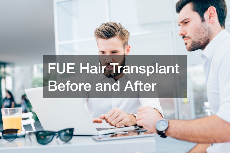 FUE Hair Transplant Before and After